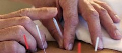acupuntura-franca-1470175832